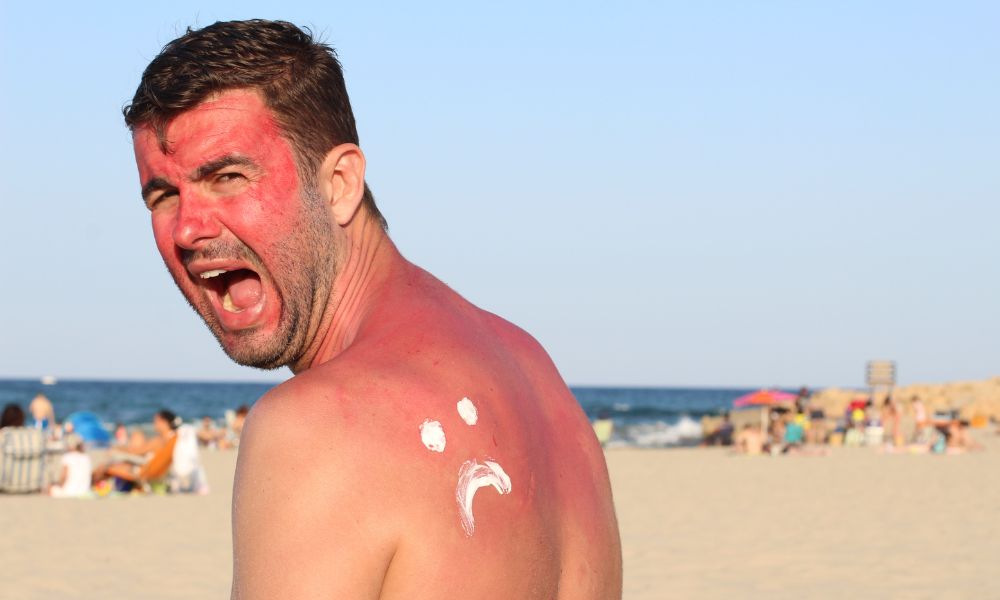 How To Treat Sunburn Naturally