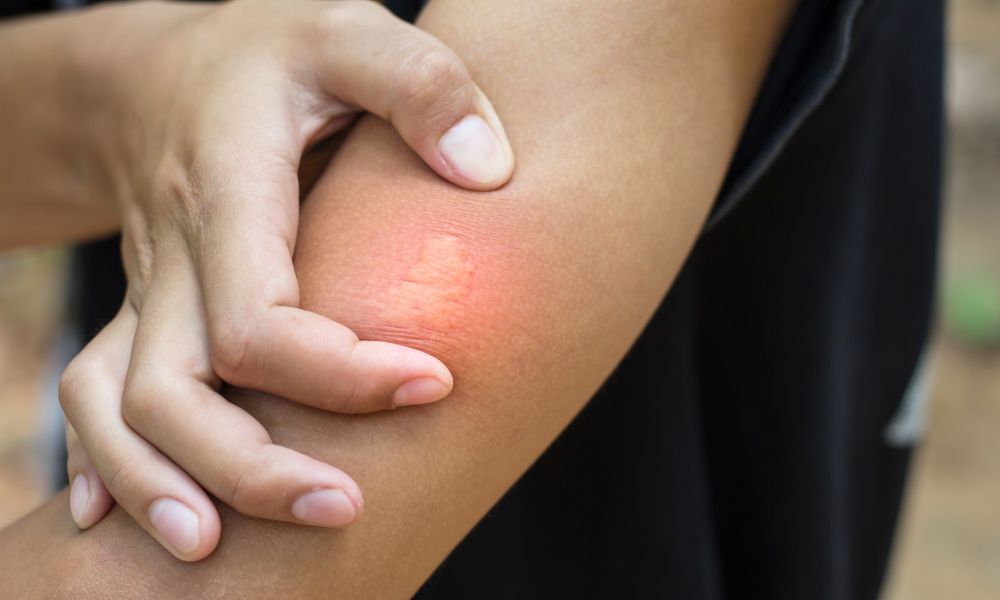 Treatment for Bee Bite
