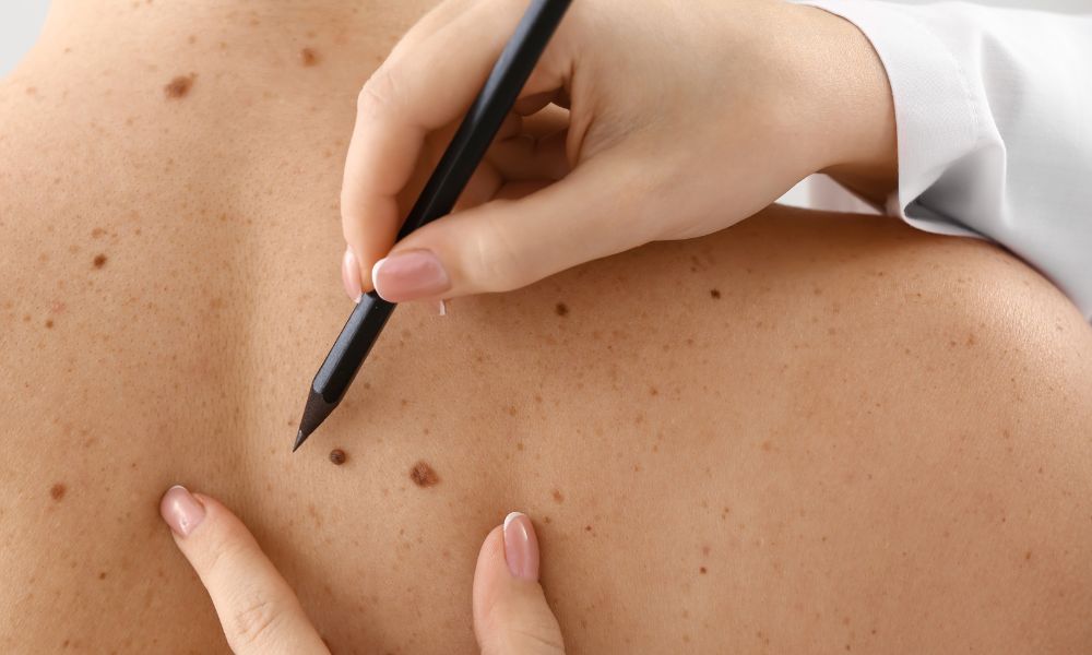 Skin cancer prevention guide