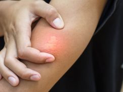 Treatment for Bee Bite