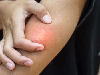 Treatment for Bee Bite