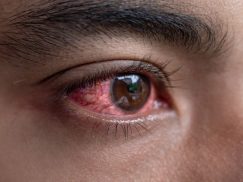 Red eye treatment