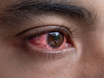 Red eye treatment