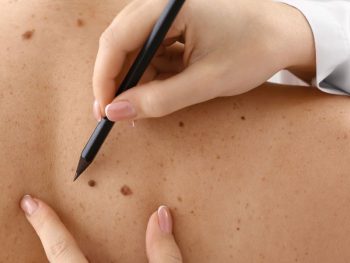 skin-cancer Skin cancer prevention guide