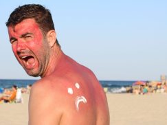 How To Treat Sunburn Naturally