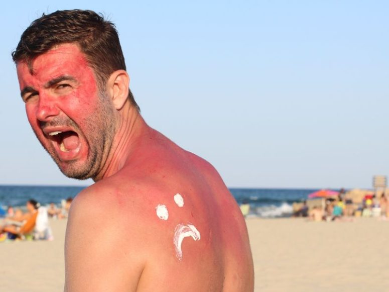 How To Treat Sunburn Naturally